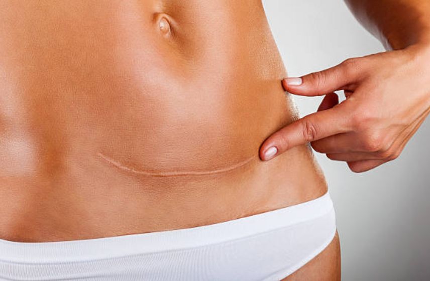 LSCS surgery in Pune by Dr Shruti Patil – expert gynecologist providing safe Caesarean deliveries and personalized maternity care.
