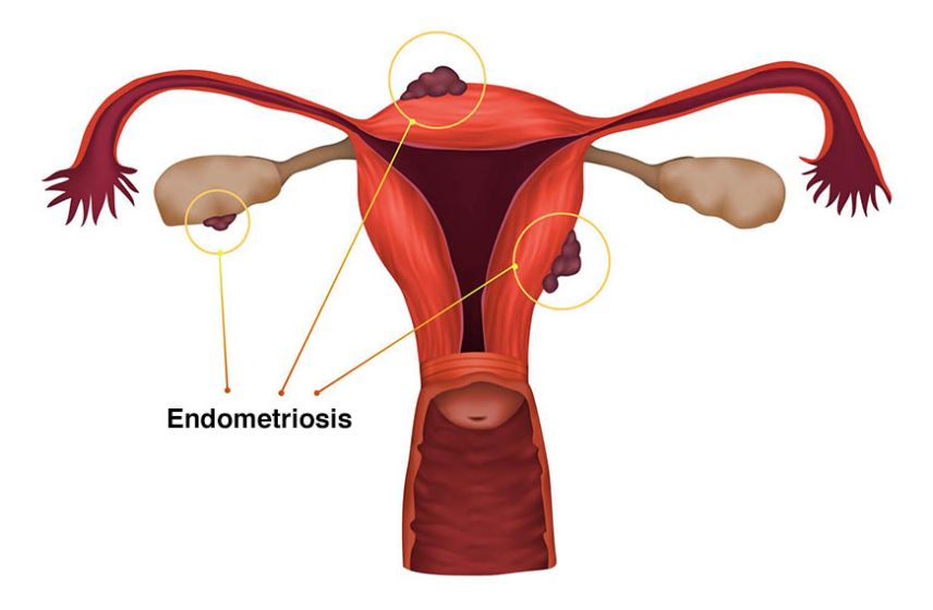 Endometriosis Treatment in Pune | Dr Shruti Patil – Expert in Pelvic Pain & Fertility Care Endometriosis treatment in Pune with Dr Shruti Patil — expert care for pelvic pain, infertility, and women’s reproductive health