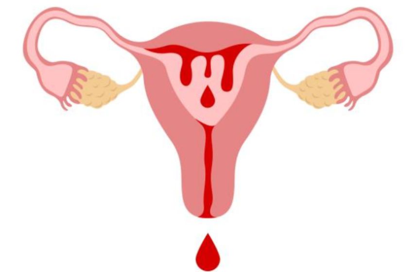Dr. Shruti Patil providing advanced treatment for abnormal uterine bleeding (AUB) in Pune.