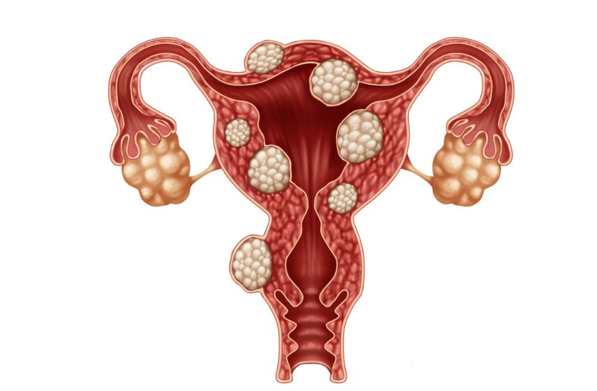 Dr. Shruti Patil providing advanced fibroid treatment in Pune.