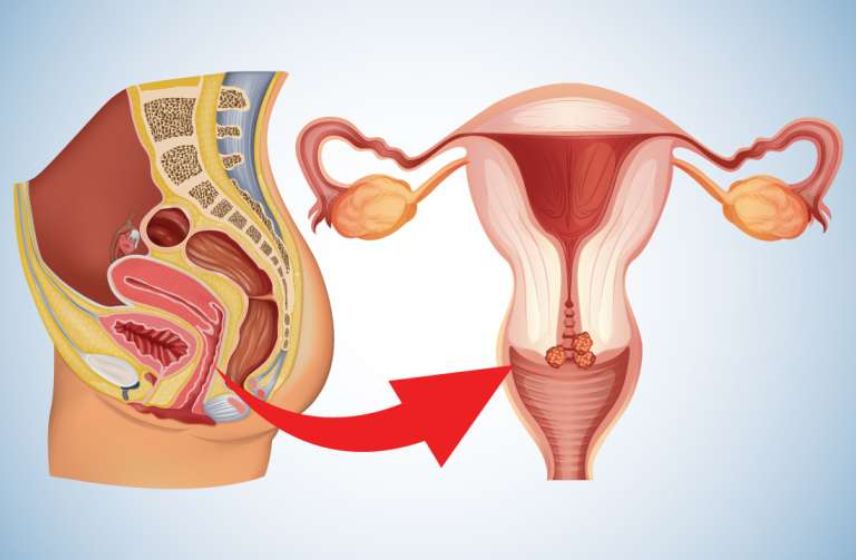 Advanced Cervical Cancer Care and Screening in Pune – Dr. Shruti Patil Dr. Shruti Patil providing expert cervical cancer screening and treatment in Pune.