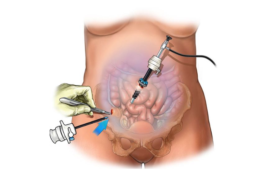 Advanced laparoscopic surgery in Pune by expert gynecologist Dr. Shruti Patil using minimally invasive techniques for faster recovery.