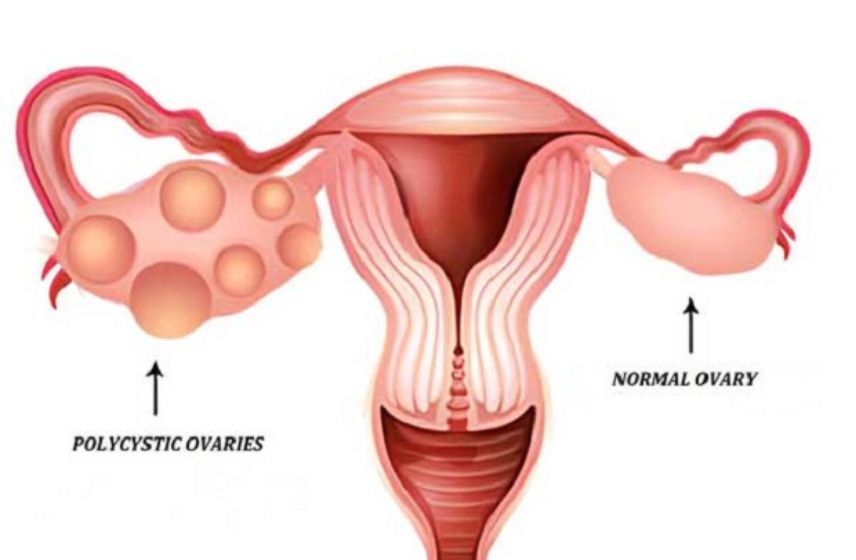 PCOD Treatment in Pune | Dr Shruti Patil – Specialist for Hormonal & Fertility Care PCOD treatment in Pune with Dr Shruti Patil — expert care for hormonal balance, fertility, and women’s health