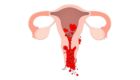 Abnormal Uterine Bleeding Treatment in Pune – Dr Shruti Patil providing expert care for heavy or irregular periods with advanced diagnosis and therapy.