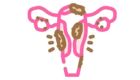 Medical illustration showing endometrial tissue growth outside the uterus causing pelvic pain.